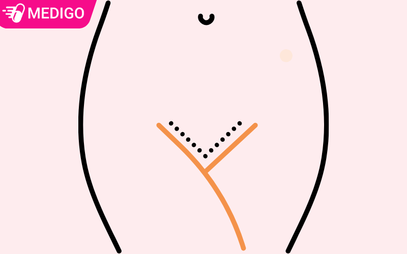 Ngứa mép vùng kín là bị gì? Những nguyên nhân thường gặp
