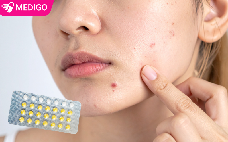 Uống thuốc tránh thai hàng ngày có nổi mụn không? Cách hiểu đúng 