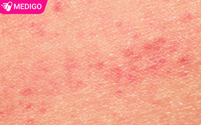 Ngứa vùng kín như kiến bò: 7 yếu tố có thể gây kích ứng