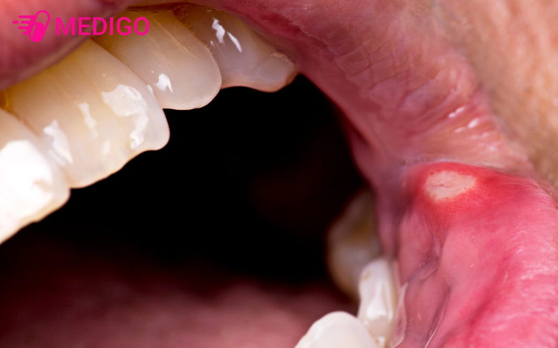 Tre-bi-nhiet-mieng-thuong-co-cac-vet-loet-dac-trung