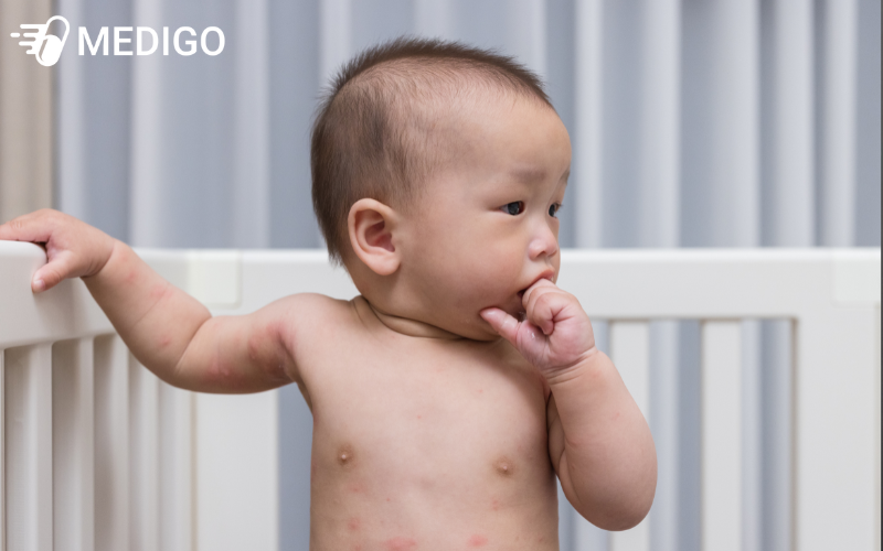 Trẻ bị nổi mẩn đỏ như muỗi đốt: Nguyên nhân và cách xử lý nhanh an toàn