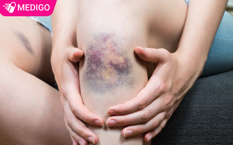 Thuốc tan máu bầm công dụng và hướng dẫn dùng đúng cách