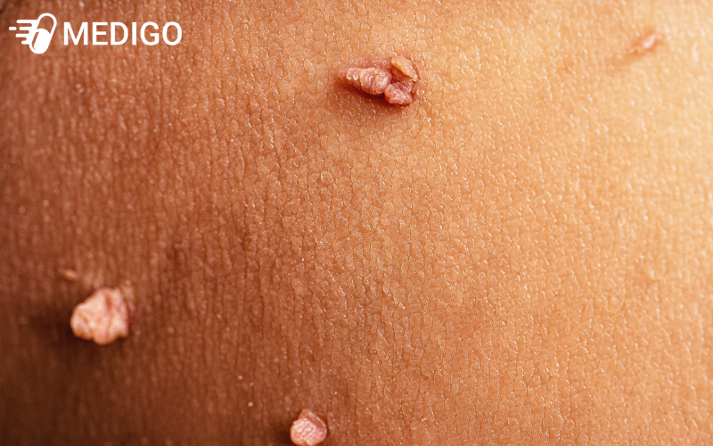 Vac-xin-HPV-con-giup-phong-ngua-mun-coc-sinh-duc