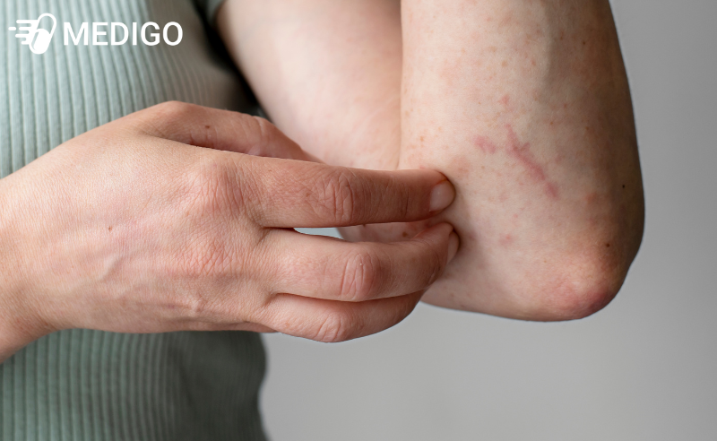 Vet-thuong-thuong-keo-dai-thanh-vet-hoac-dam-do-doc-to-lan-theo-duong-kien-bo-hoac-theo-tay-nguoi-cha-xat