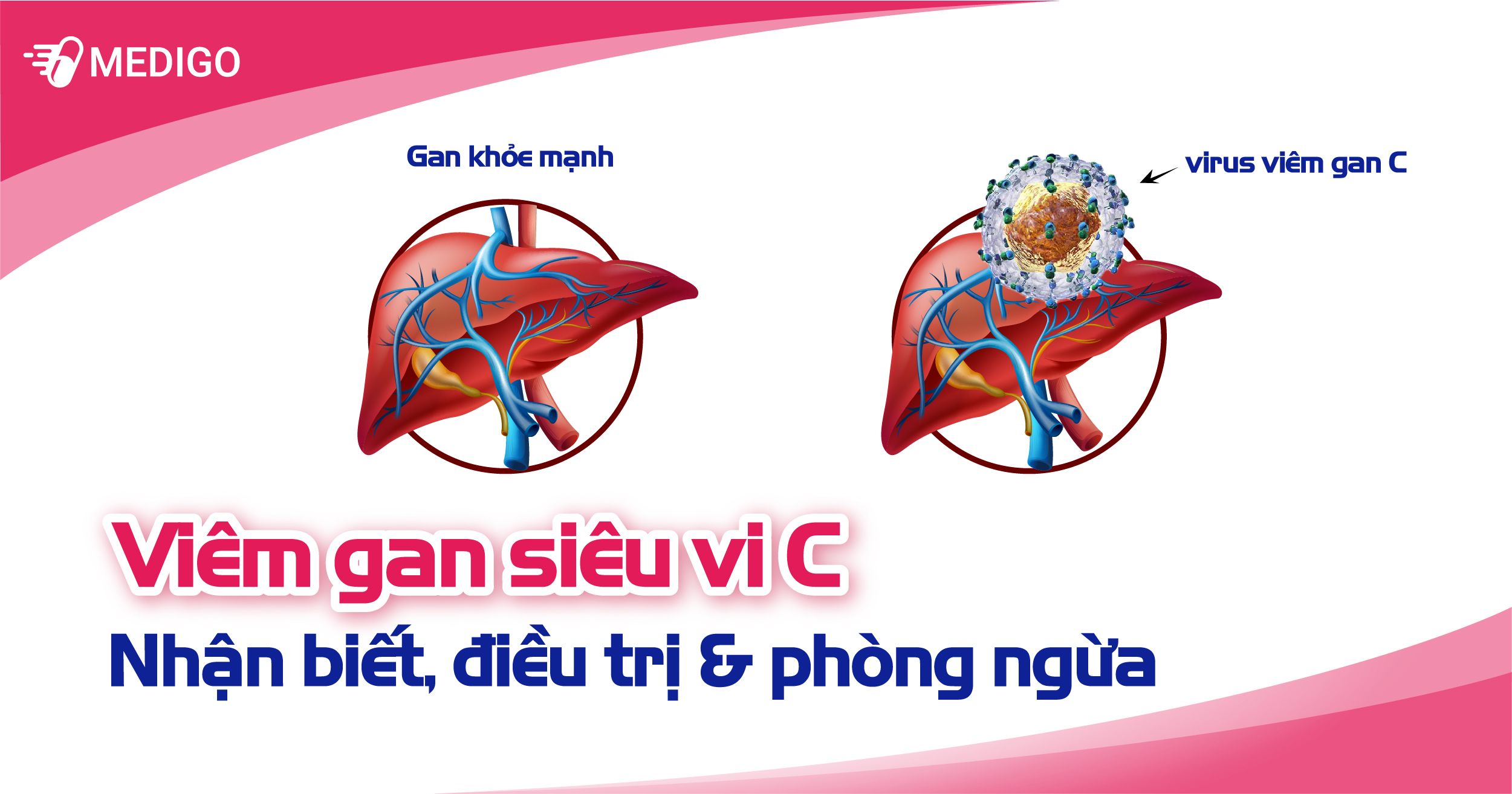 Viêm gan C: Nhận biết, điều trị và phòng ngừa