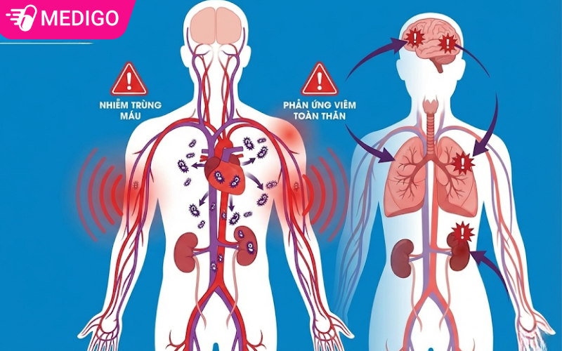 anh-minh-hoa-co-the-bi-nhiem-trung-mau