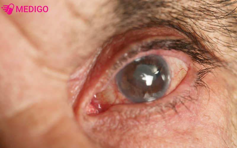 benh-cuom-nuoc-glaucoma-gay-ton-thuong-day-than-kinh-thi-giac