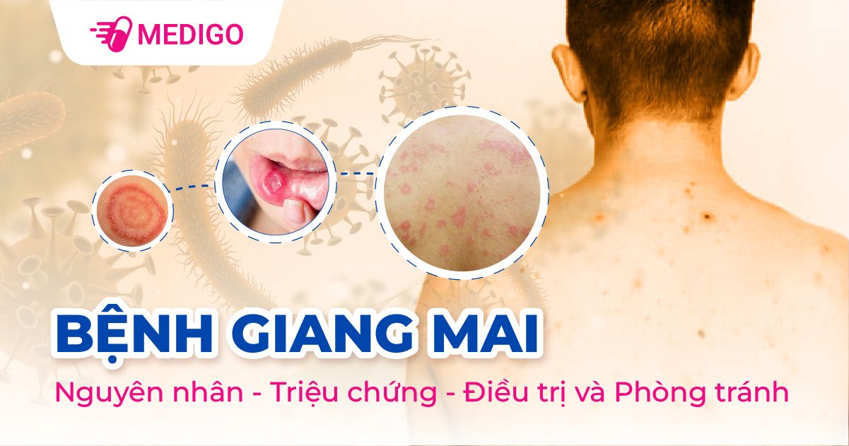 Tổng quan về bệnh giang mai