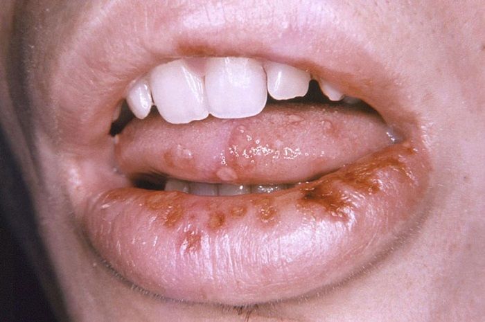 Bệnh giang mai ở miệng: những điều cần biết
