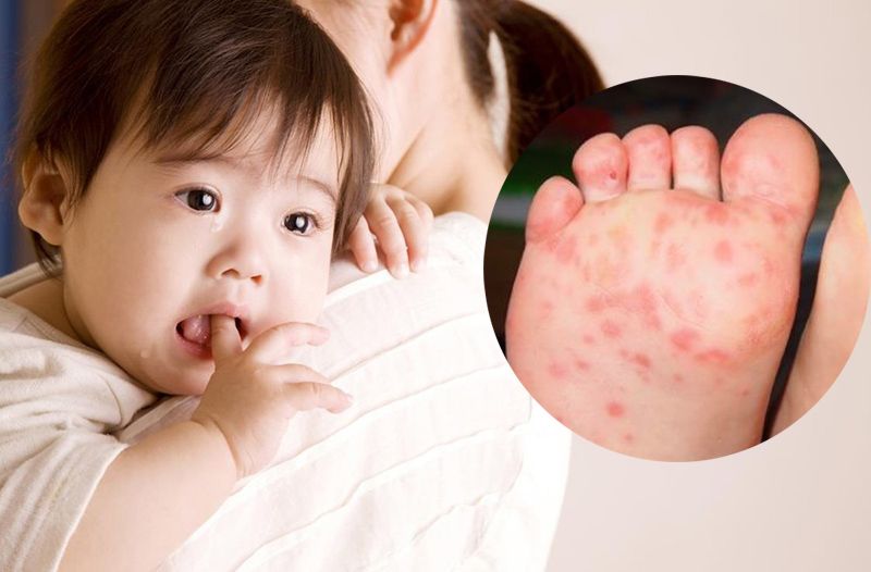 Bệnh tay chân miệng ở trẻ em có lây không?