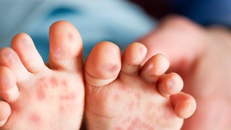 Bệnh tay chân miệng ở trẻ có tự khỏi không?