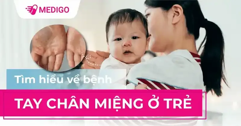 Tổng quan về bệnh tay chân miệng