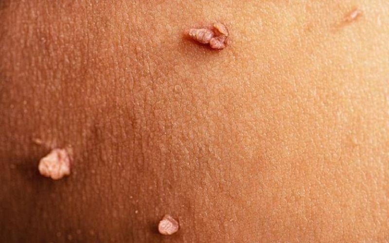 bị sùi mào gà nhưng xét nghiệm hpv âm tính