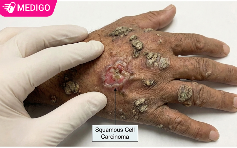 bien-chung-cua-hoi-chung-nguoi-cay-la-ung-thu-da-khong-hac-to