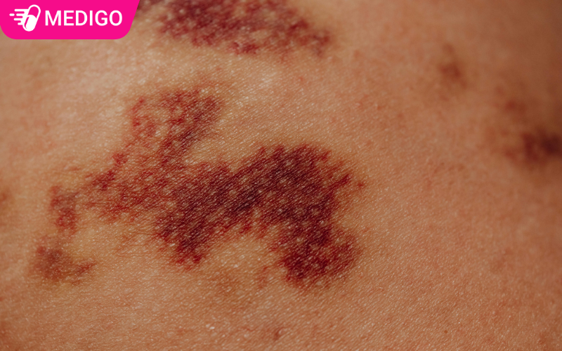 Mao-mach-bi-anh-huong-tu-lai-duoi-da-gay-vet-tim-bam