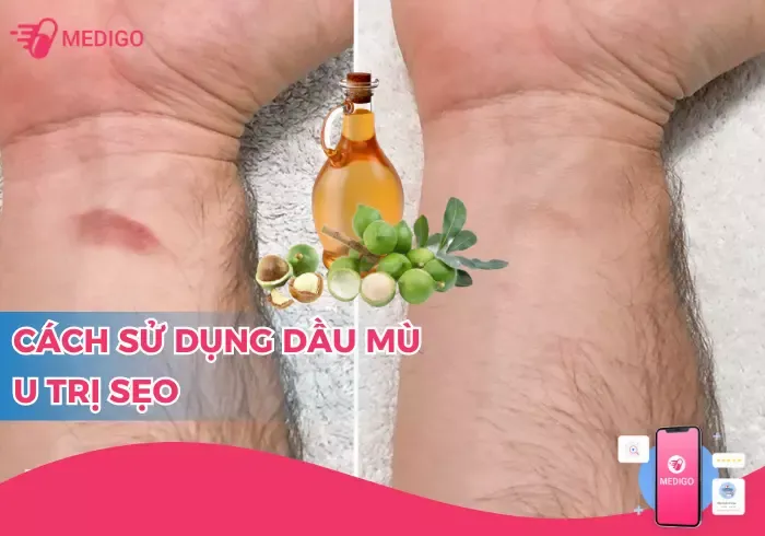 dầu mù u trị sẹo