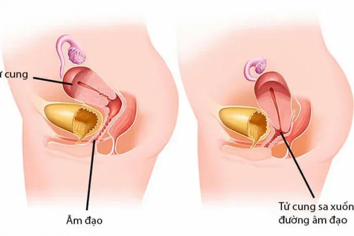 cây thầu dầu tía chữa sa tử cung