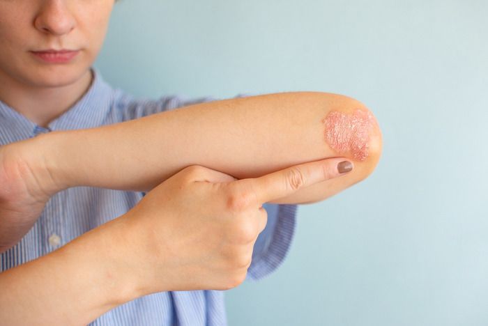 cây vòi voi chữa vảy nến