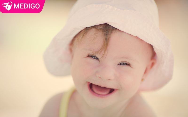 dac-diem-ngoai-hinh-cua-nguoi-mac-hoi-chung-down-de-nhan-biet