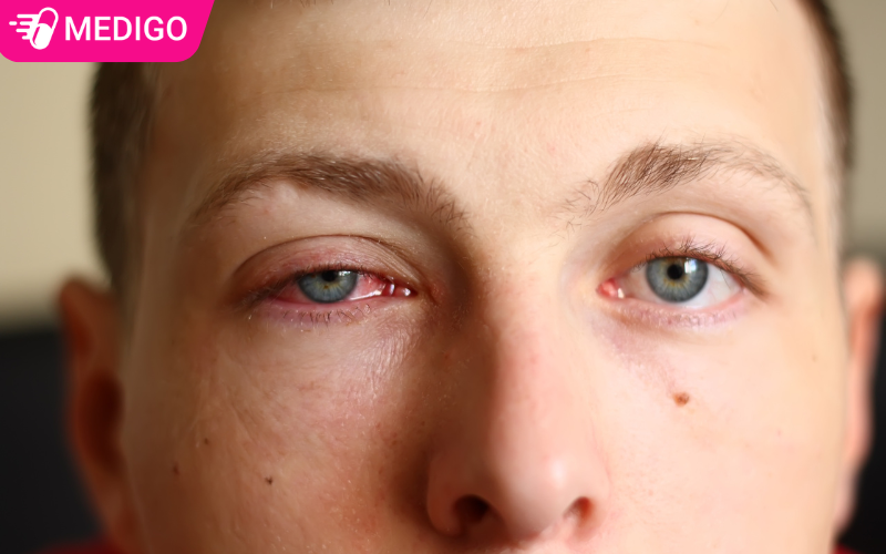 Đau mắt đỏ: Nguyên nhân, triệu chứng, cách điều trị và ngừa lây nhiễm