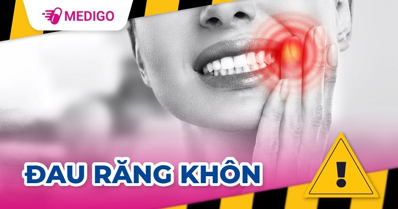 Răng khôn là răng nào? Khi nào nên nhổ?