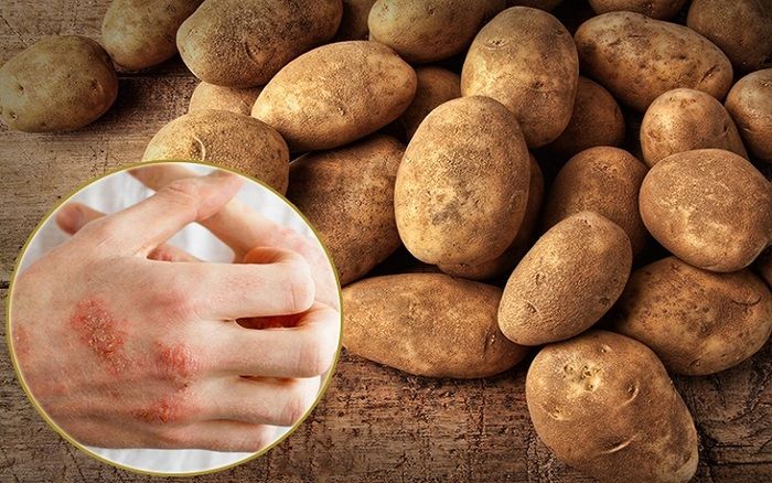 Dị ứng khoai tây: Biểu hiện, cách phòng tránh