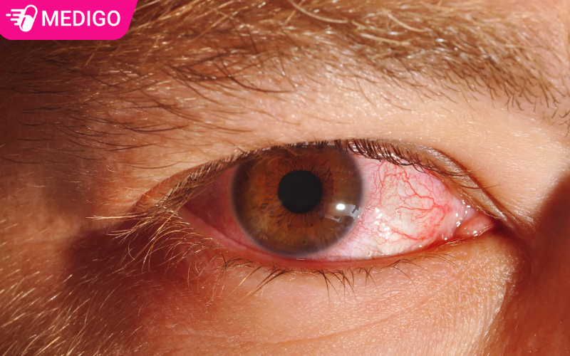 hinh-anh-benh-dau-mat-do-hay-con-goi-la-viem-ket-mac