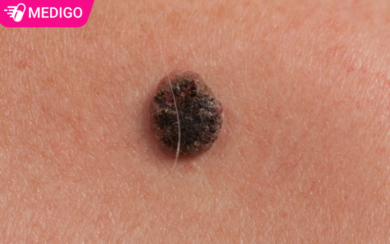 hinh-anh-khoi-u-hac-to-tren-da