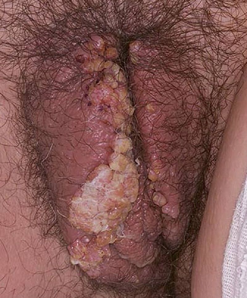 hpv lây qua đường nào