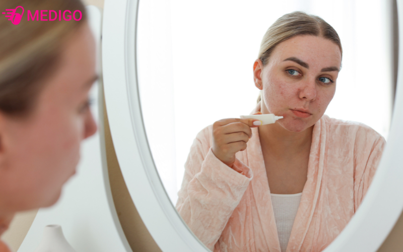 huong-dan-cham-soc-da-mun-khoa-hoc