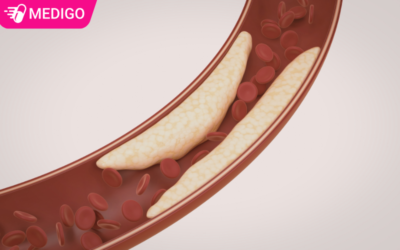 Mo-mau-cao-gay-tich-tu-mang-xo-vua-trong-long-mach-mau