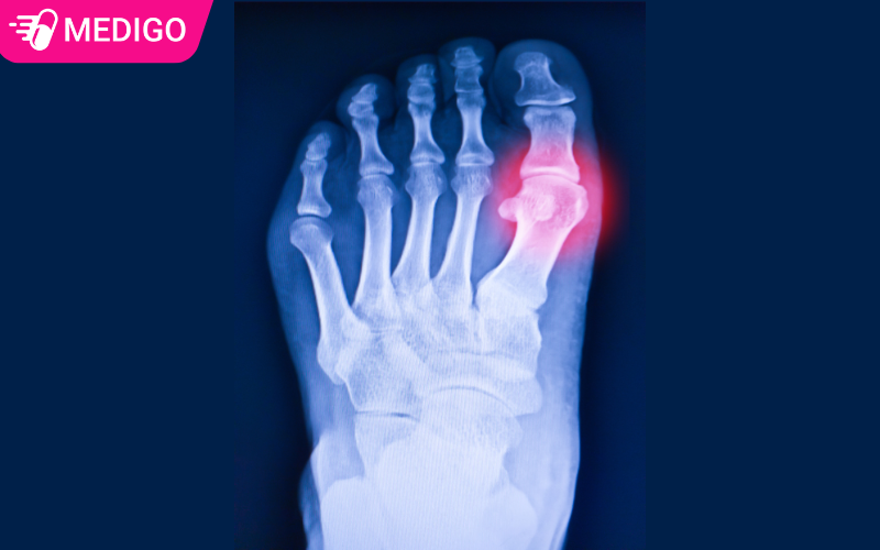 Cac-giai-doan-phat-trien-cua-benh-Gout-ban-can-luu-y