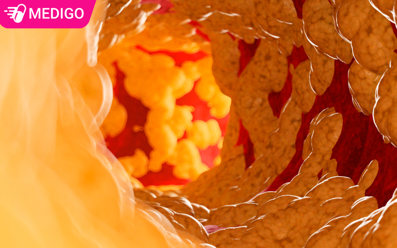 Cholesterol-va-triglycerid-cao-lam-hep-mach-mau-tang-nguy-co-tim-mach