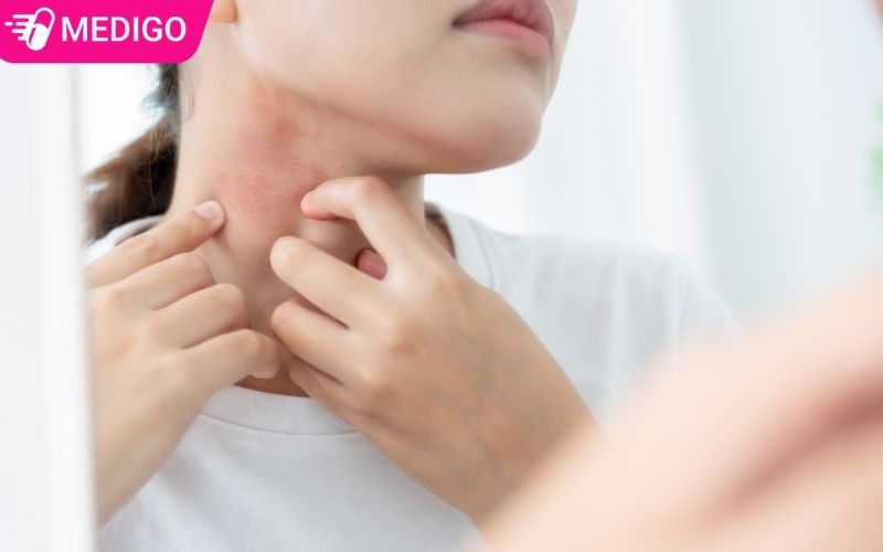 Bai-thuoc-dan-gian-dieu-tri-man-ngua-voi-chut-chit