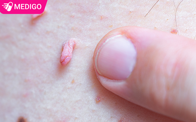 Sui-mao-ga-la-benh-gi