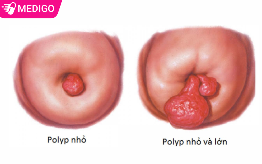 4-Truong-hop-ra-mau-do-polyp-co-tu-cung-BAT-BUOC-can-dieu-tri-ngay