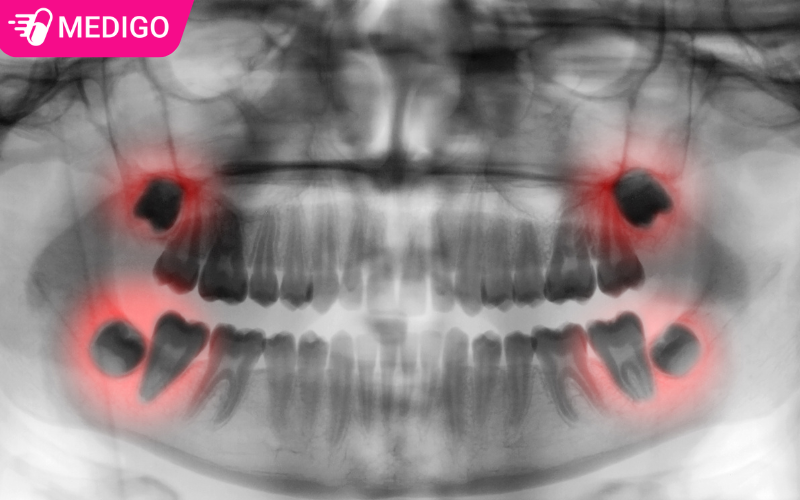 Nguoi-truong-thanh-co-the-co-toi-da-4-rang-khon