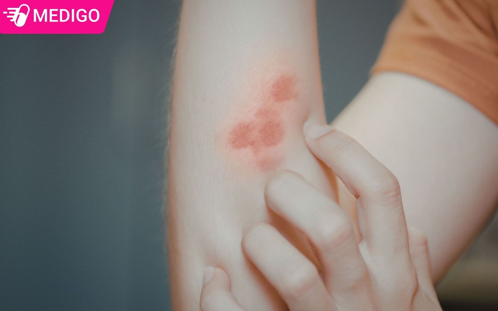 Dai-phu-binh-thuong-duoc-su-dung-trong-truong-hop-man-ngua