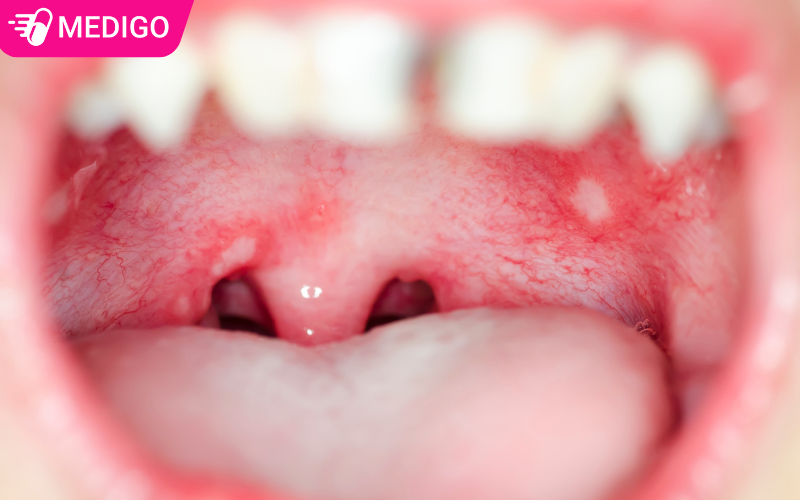 Niem-mac-hong-do-dau-hieu-viem-hong-va-ton-thuong-niem-mac-mieng