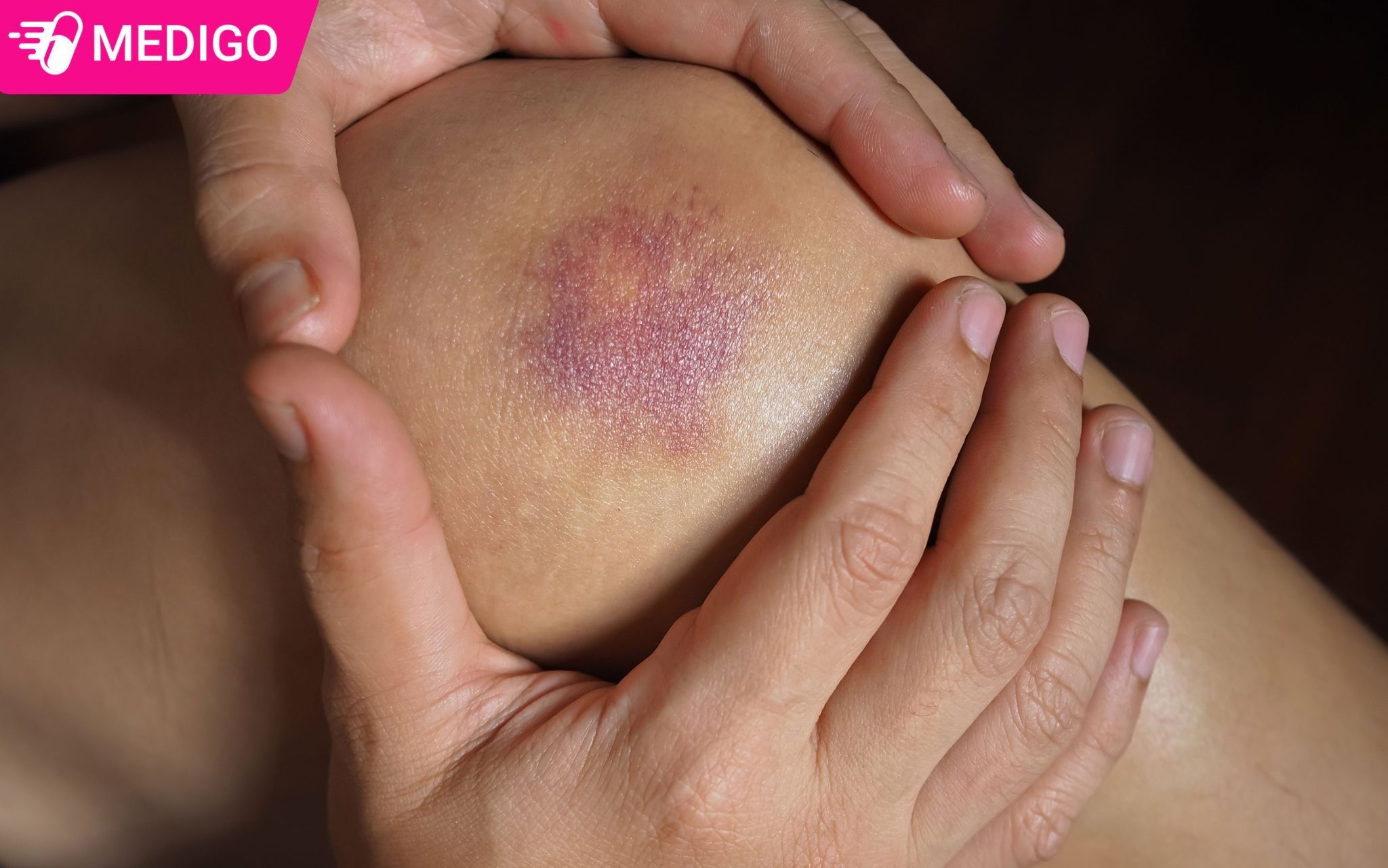 Cay-mo-qua-ho-tro-cai-thien-vet-thuong-lau-lanh