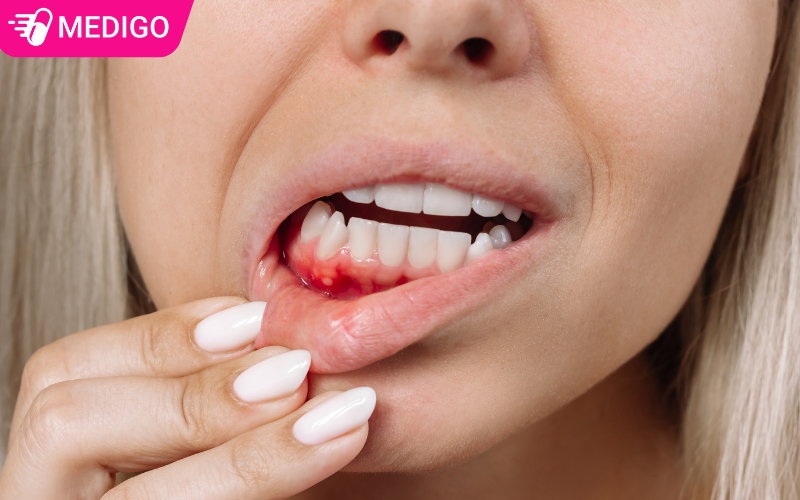 Ton-thuong-viem-va-loet-o-moi-trong-gay-dau-rat-khi-an-uong