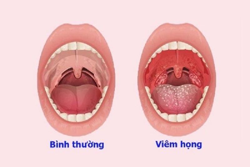 Viêm họng hạt