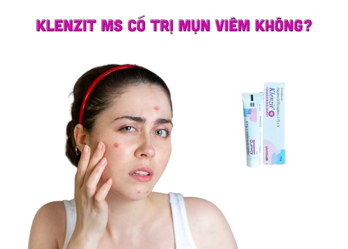 Giải đáp: Klenzit MS có trị mụn viêm không?