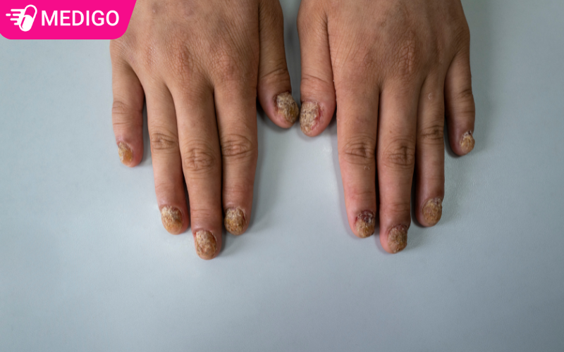 nam-mong-lau-ngay-co-the-lam-bien-dang-mong