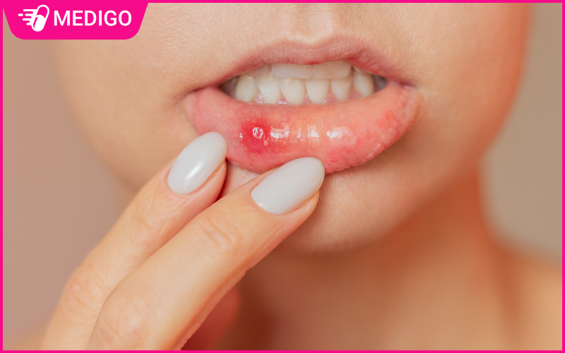 Nhiệt miệng là gì? 5 Bước xử lý nhanh chóng an toàn