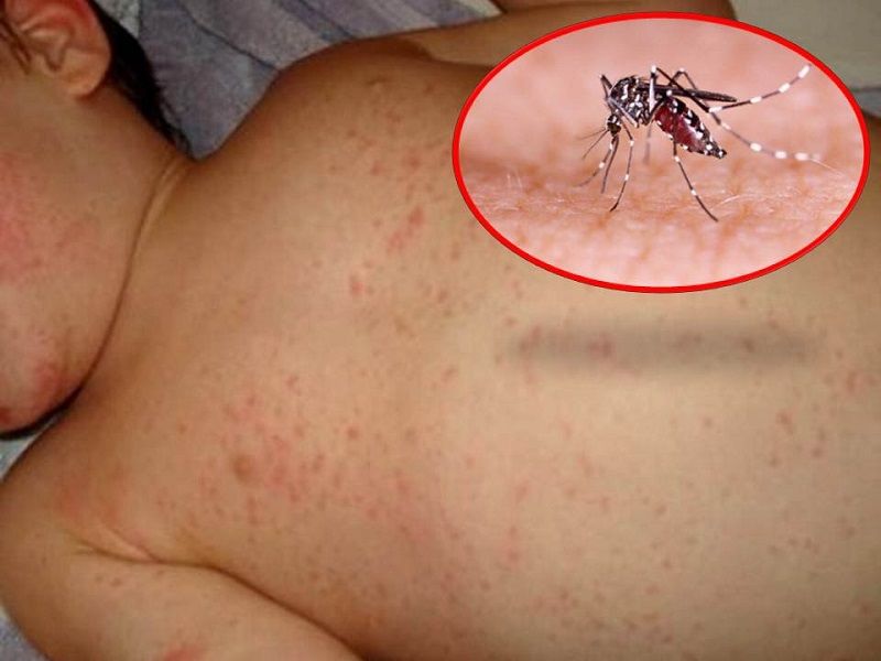 Sốt xuất huyết Dengue