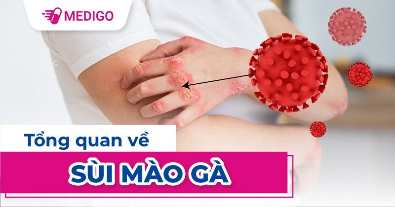 Sùi mào gà ở nam giới: nguyên nhân, biểu hiện, phương pháp điều trị và cách phòng ngừa