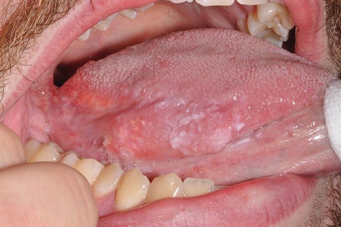 Sùi mào gà ở miệng: dấu hiệu nhận biết để tránh nhầm lẫn với các bệnh lý khác