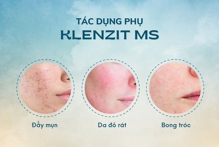 tác dụng phụ của klenzit ms