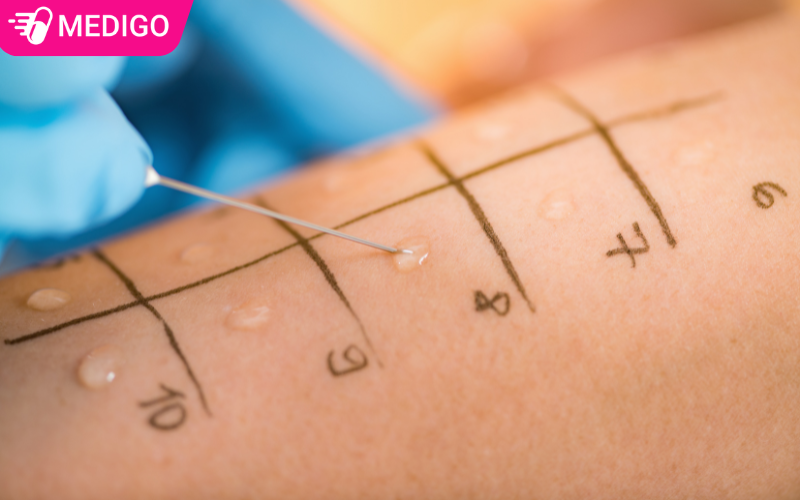 test-lay-da-de-tim-ra-nguyen-nhan-gay-di-ung-da